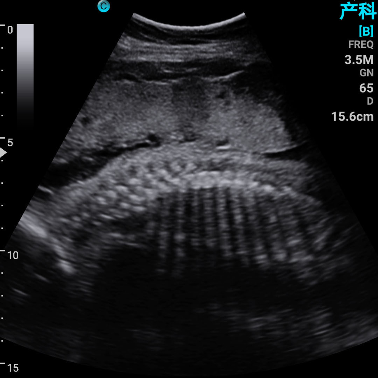 胎儿脊柱，B模式