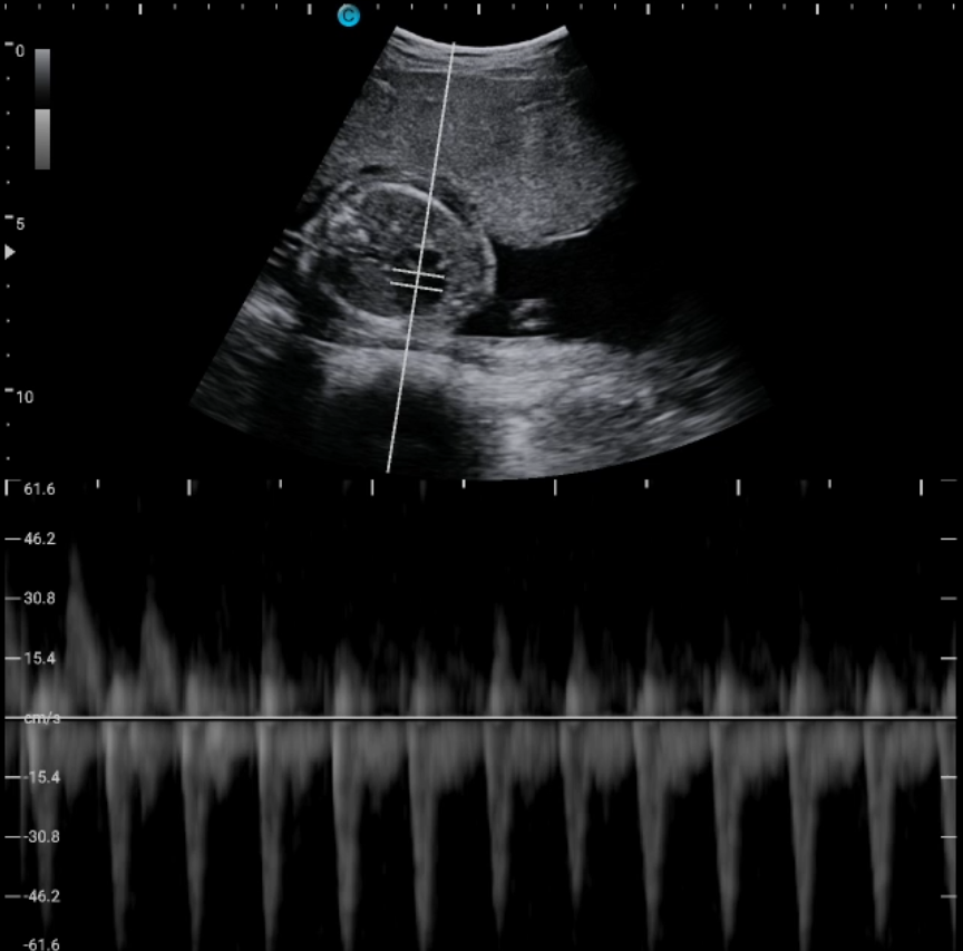 胎儿心脏，PW模式