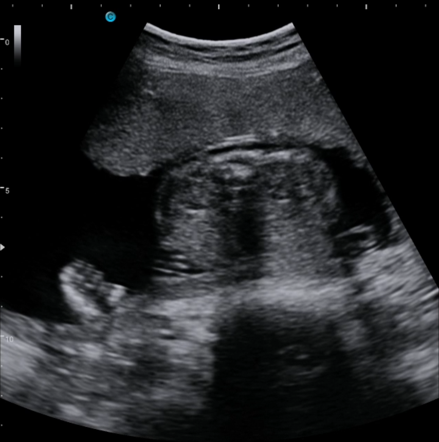 胎儿肾脏，B模式